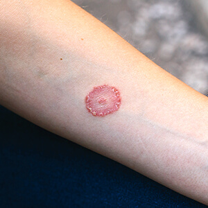 Prickly heat and skin rashes
