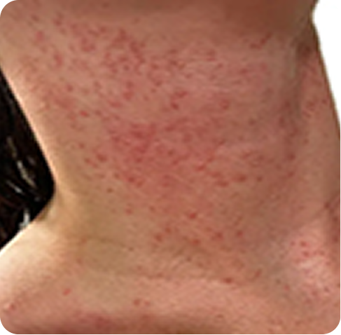 Prickly heat and skin rashes