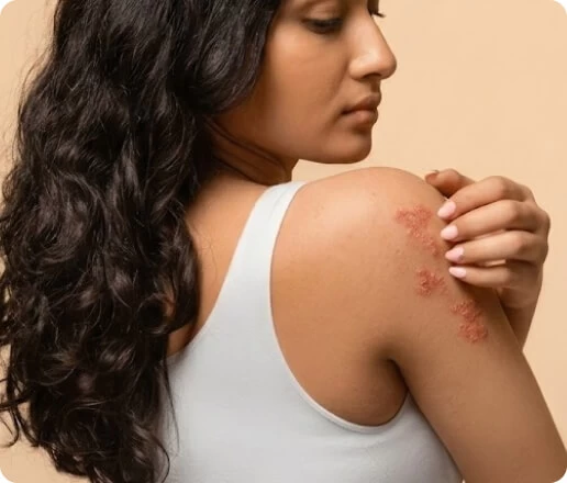 How to Manage Severe Summer Chafing and Rashes
