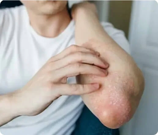 When Trapped Sweat Turns Into Fungal Concerns
