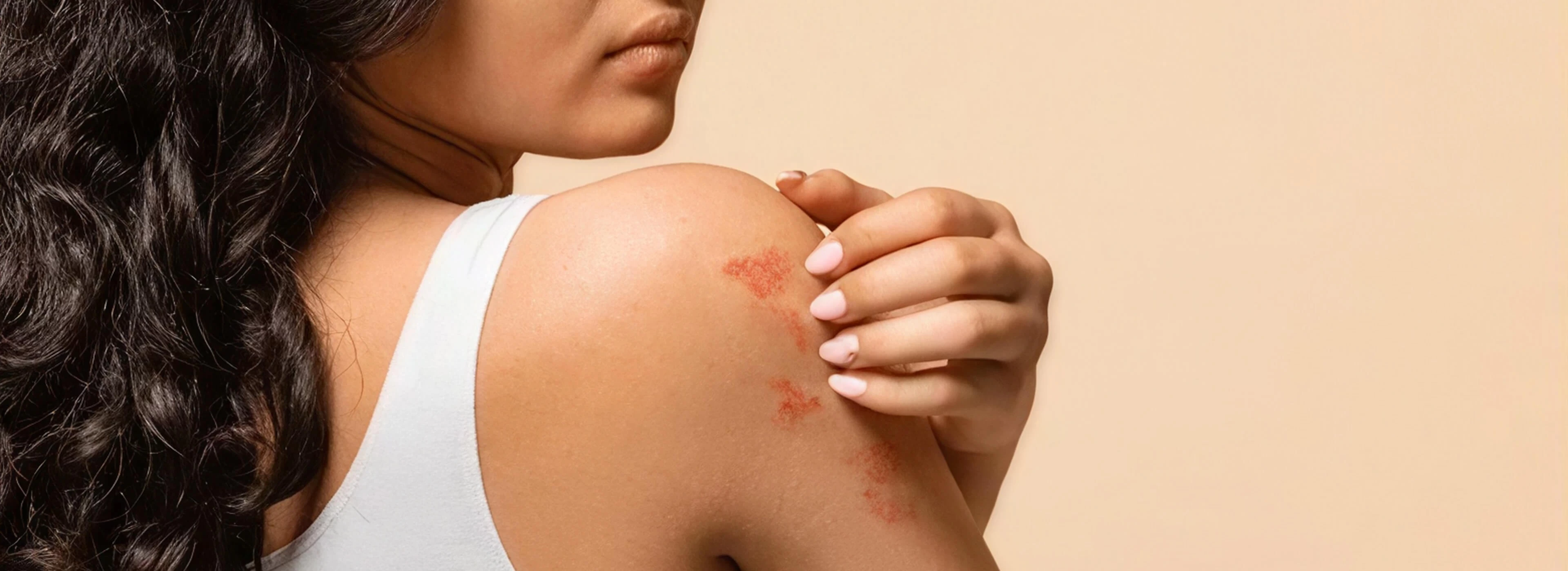 How to Manage Severe Summer Chafing and Rashes