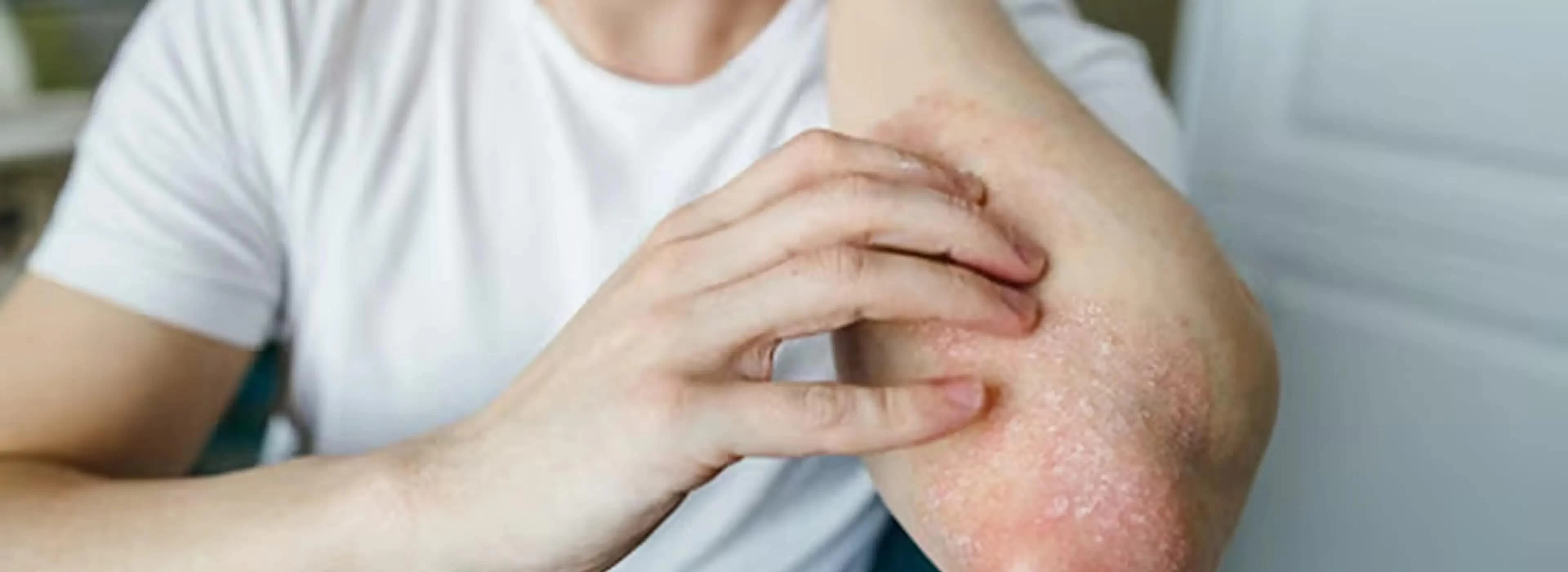When Trapped Sweat Turns Into Fungal Concerns