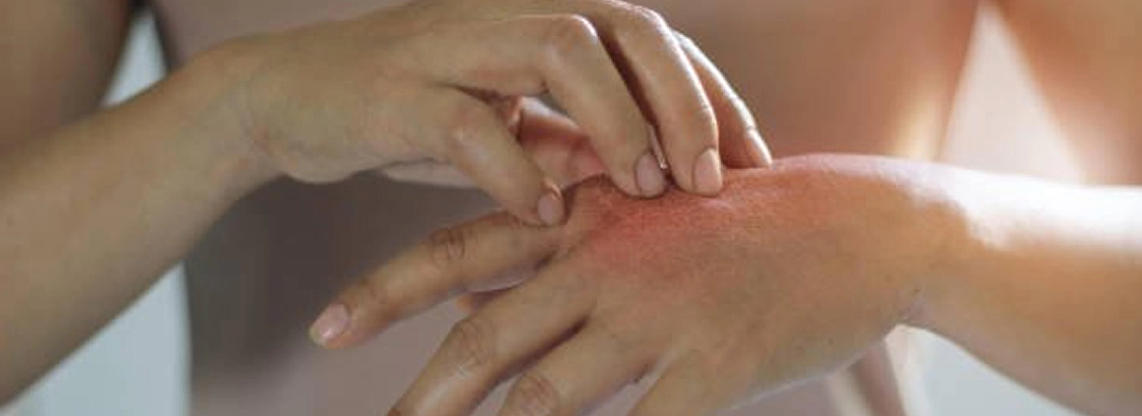 The Hidden Danger of Scratching a Fungal Rash
